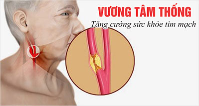 Xơ vữa động mạch cảnh là nguyên nhân chính gây đột quỵ não.jpg